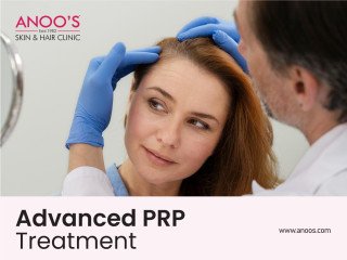 Advanced PRP Treatment for Hair Growth at Anoos