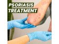 effective-homeopathic-treatment-for-scalp-psoriasis-a-path-to-permanent-relief-small-0