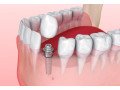 trusted-dental-clinic-in-tijuana-comprehensive-care-for-a-brighter-healthier-smile-small-0