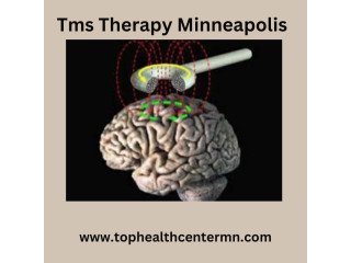 Exploring TMS Therapy in Minneapolis
