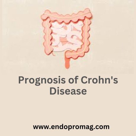 navigating-the-prognosis-of-crohns-disease-big-0