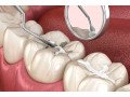 best-dental-sealant-treatment-clinic-in-dubai-uae-small-0