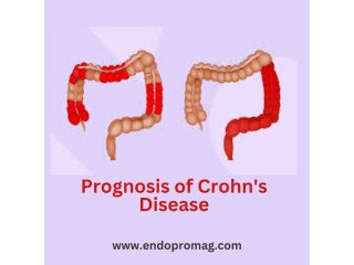 What Determines the Prognosis of Crohn's Disease?