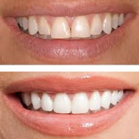 best-dental-bonding-treatment-clinic-in-dubai-uae-big-0