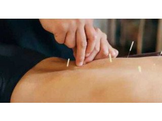 Effective Dry Needling Therapy Texas for Pain Relief