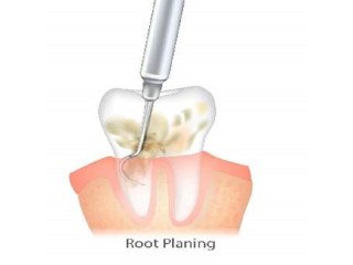 Best Root planning treatment in Dubai UAE